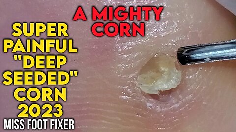 SUPER PAINFUL " DEEP SEEDED CORN" 2023 [ A MIGHTY CORN] BY FOOT DOCTOR MISS FOOT FIXER