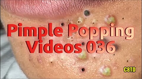 Satisfying Pimple Popping Videos 036
