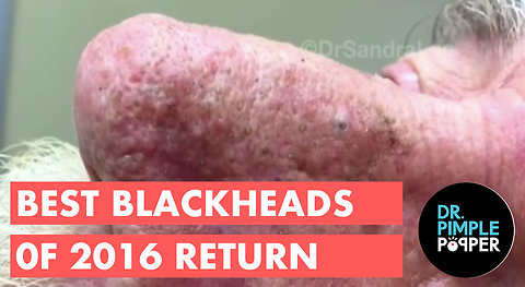Best of Dr Pimple Popper Blackheads 2016 revisited 2018