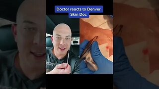 Derm reacts to mystery removal! #mystery #extraction #dermreacts