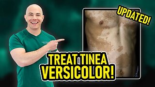 How to Treat Tinea Versicolor and Keep it From Coming Back (Dermatologist Updated 2023!)