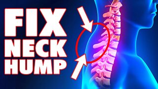 How To Fix Your Neck Hump Now (Simple Exercise)