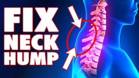 How To Fix Your Neck Hump Now (Simple Exercise)