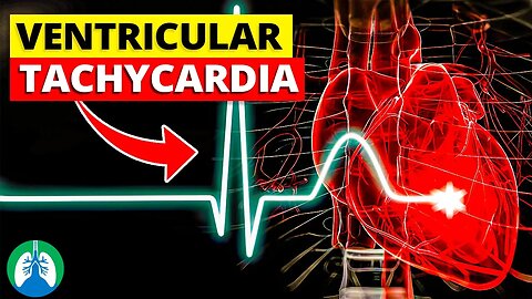 Ventricular Tachycardia (V-tach) | Medical Explainer Video