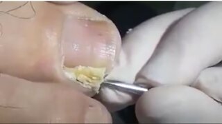 Big Ingrown Toenail Removal!!!!