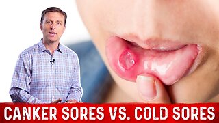 Canker Sores Vs Cold Sores – Dr. Berg on Mouth Sores