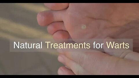 Natural Treatments for Warts