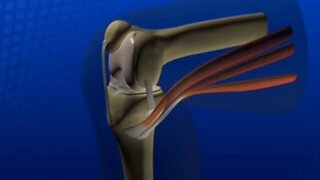 Parafuso partido no joelho, ligamento cruzado anterior.