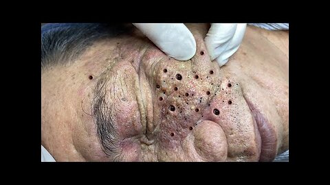 Watch the Most Satisfying Pimple Pops Ever! #PimplePopper #Satisfying #Skincare