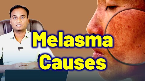 Risk Factors, Triggering Factors and Causes for Melasma Treatment & Cure | Melasma Solution Remedy