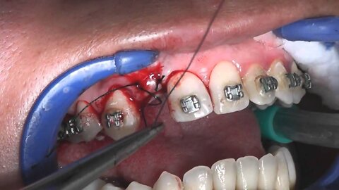 Wisdom Tooth Removal, Wisdom Tooth Extraction #06