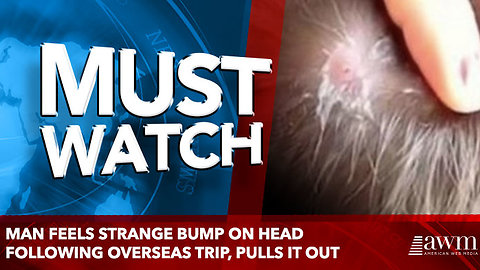 Man Feels Strange Bump On Head Following Overseas Trip, Pulls It Out