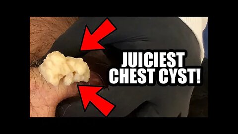 Juiciest Chest Cyst