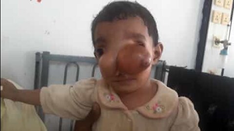 Atteint d'un rare anomalie nasale, cet enfant subit une opération