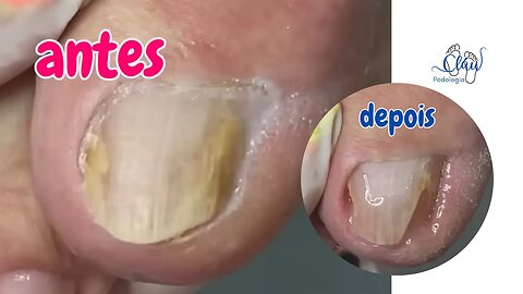 Será que é micose na minha unha? #unhas #pes #dor #podologia #unhaencravada #micose #fungos