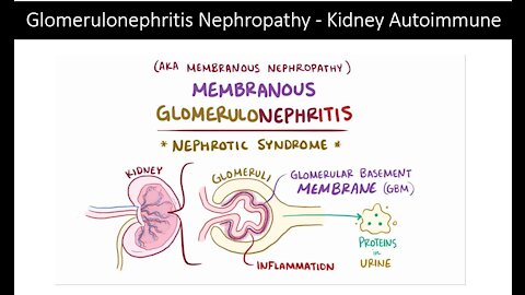Kidney Autoimmune Glomerulonephritis Nephropathy - Natural Treatment