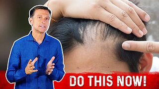 Receding Hairline: Causes And Remedies – Dr.Berg