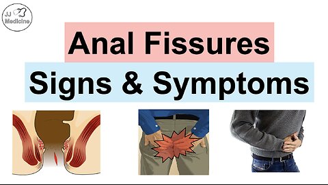 Anal Fissures Signs & Symptoms (& Why They Occur) | Acute vs Chronic Anal Fissures