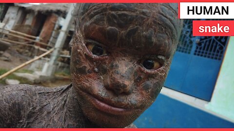 Ten-year-old boy dubbed 'human snake' due to rare skin condition