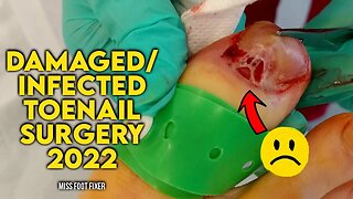 DAMAGED/INFECTED TOENAIL SURGERY 2022 BY FAMOUS FOOT DOCTOR MISS FOOT FIXER