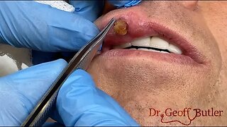 Removal of a pyogenic granuloma on the lip