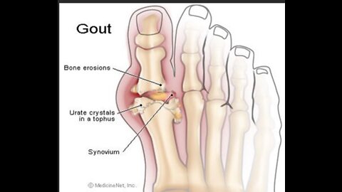 Science Lady - Gout Cure within 3 days