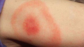 Lyme Disease and Cellular Health