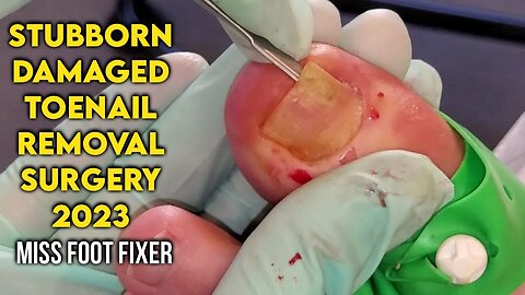 STUBBORN DAMAGED TOENAIL REMOVAL SURGERY 2023 BY FAMOUS PODIATRIST MISS FOOT FIXER