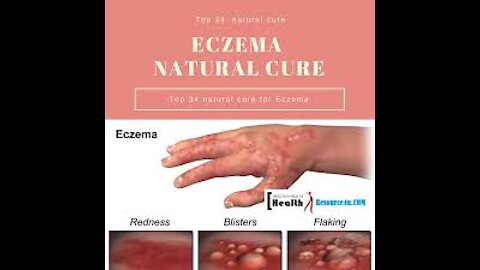 Believe me its amazing remedies for EczemaBest Natural Remedies For Eczema