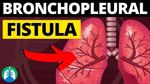 Bronchopleural Fistula (Medical Definition) | Quick Explainer Video