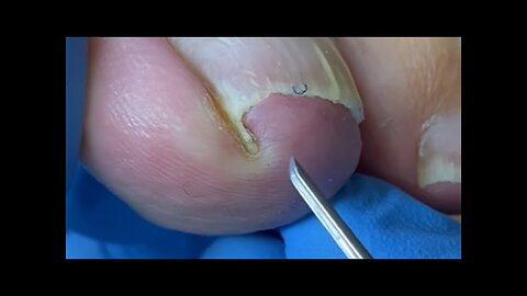 Watch Out! Don't Leave a Hook When Cutting Your Nail, Avoid This Mistake #nails #foot #viral