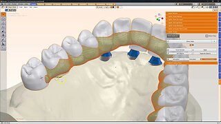 Making a waxed up bridge attached to implants