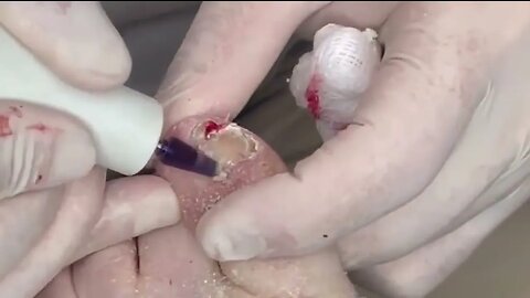 Parte 1 - Lesão na unha do dedão do pé #podologia #callus #nails #podiatrist
