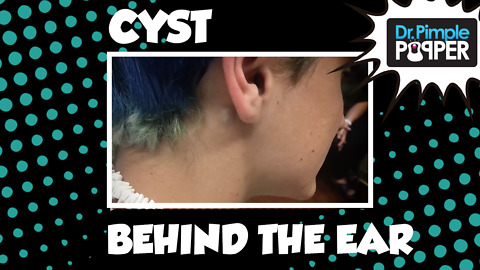 A Behind the Ear Cyst Squeeze