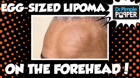 Egg-Sized Lipoma on the Left Forehead