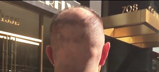 Las Vegas neurosurgeon speaks on the autoimmune disease, alopecia