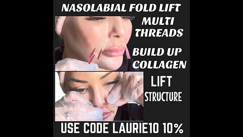 Lifting Nasolabial Folds And How I Keep My Face From falling