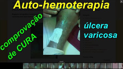 COMPROVAÇÃO DE CURA DE ÚLCERA VARICOSA PELA AUTO-HEMOTERAPIA
