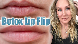 Botox Lip Flip // Full Tutorial
