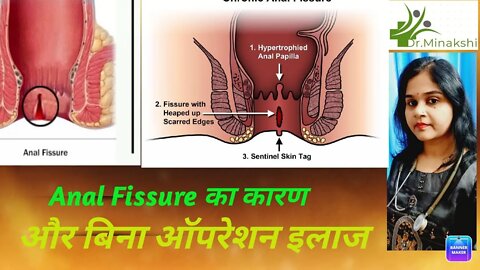 Anal fissure - Symptoms and causes - Prevention and homeopathic Treatment #fissure #drminakshisingh