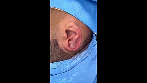 repair the ear 👂 by plastic surgery