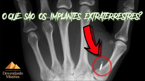 O QUE SÃO OS IMPLANTES EXTRATERRESTRES?