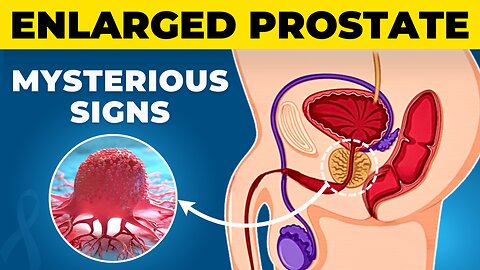 Enlarged Prostate (BPH) - Unknown Signs & Symptoms (DON'T IGNORE) Enlarged Prostate Treatment