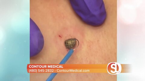 Contour Medical has scarless mole and skin tag removal