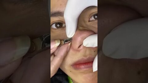 Perfect Nose Blackheads Removal