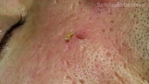 Removal / extraction of blackheads and pimples. Satisfying videos to relax!
