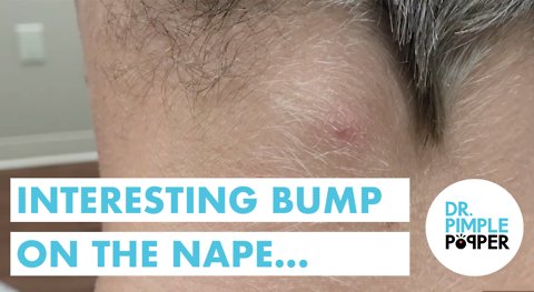 An Interesting POP on the Nape