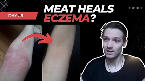 2 Months on the Carnivore Diet - Did it heal my eczema?
