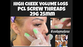 Adding PCL For High Cheeks