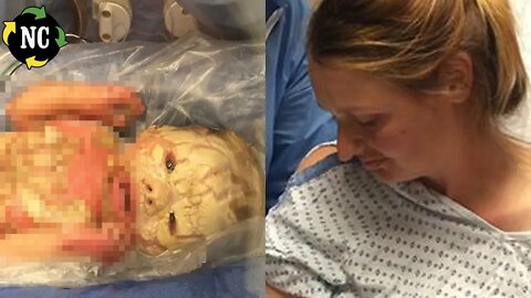 Lembra do bebê que teve o rosto trincado ao nascer? Os médicos não faziam ideia até onde ela iria